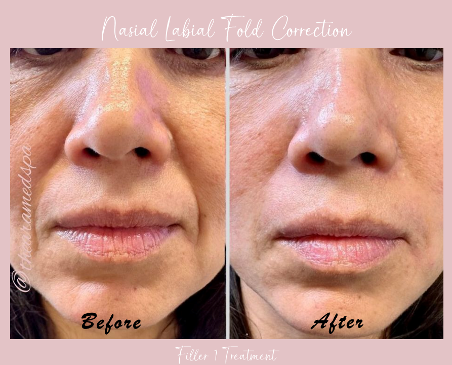 A before and after photo of a woman 's under eye correction.