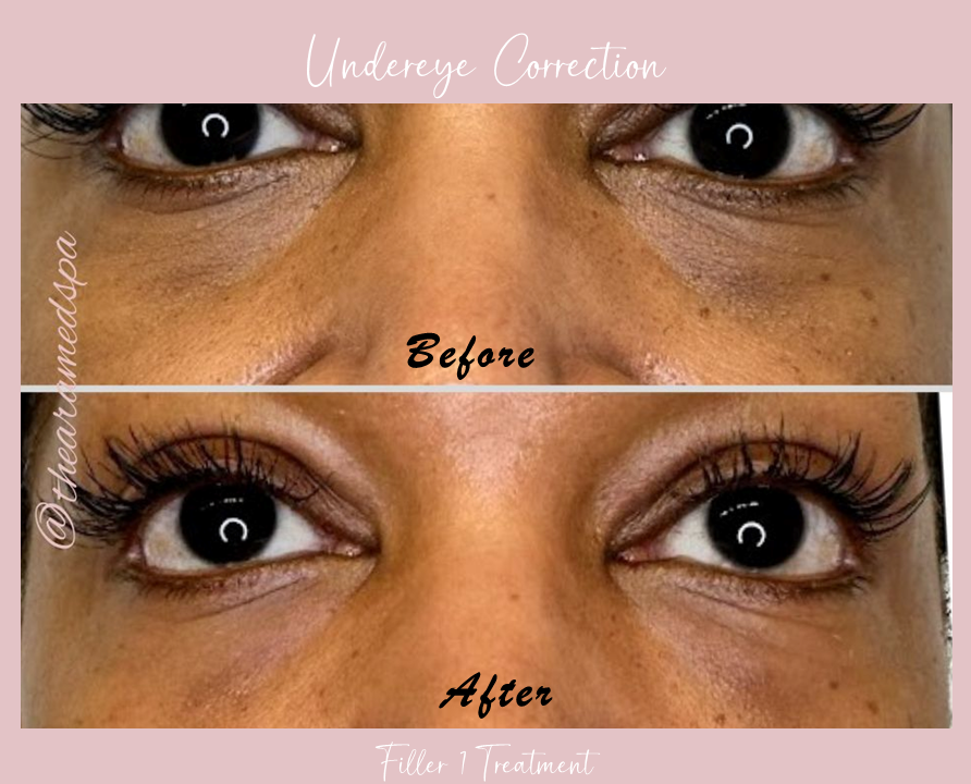 A before and after photo of a woman 's under eye correction.
