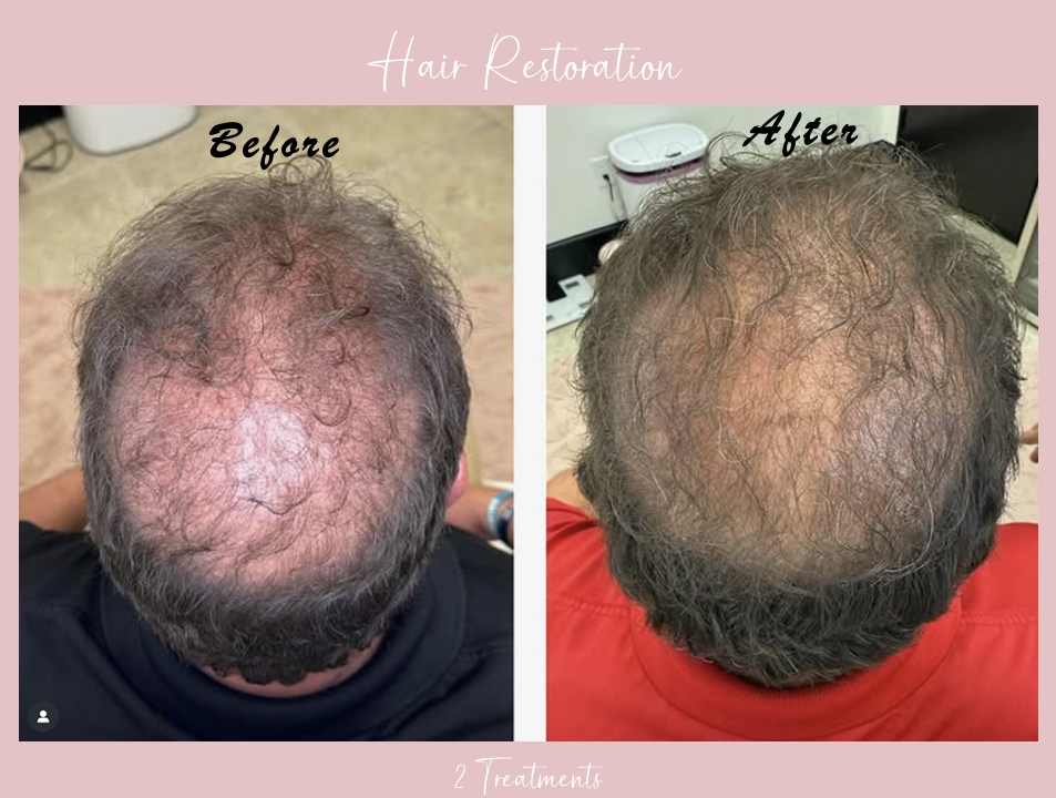 A before and after photo of a man 's hair restoration.