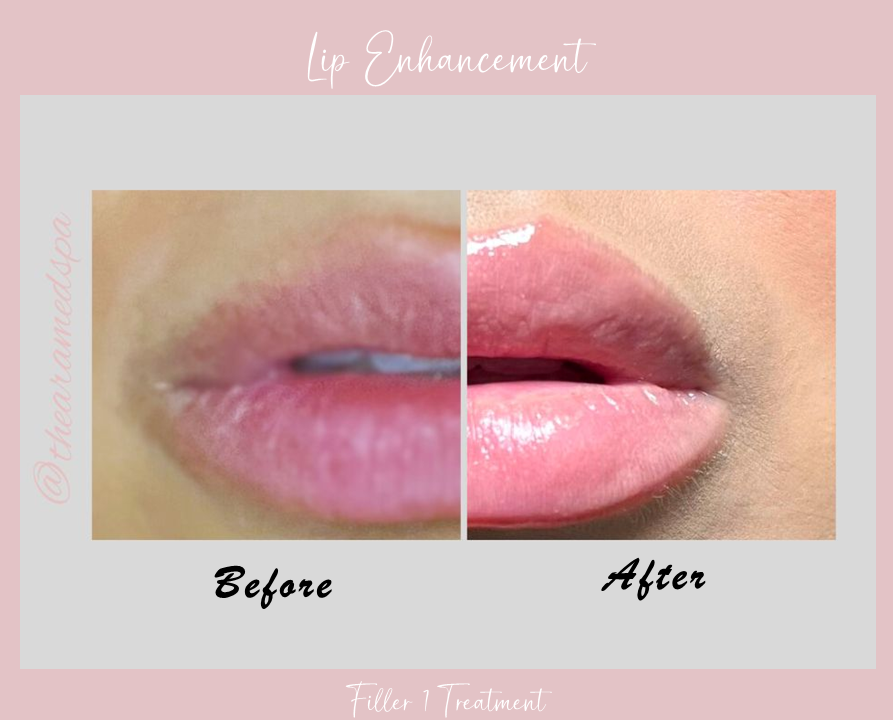 A before and after photo of a woman 's lips.