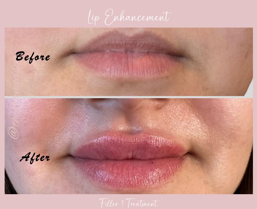 A before and after photo of a woman 's lips.