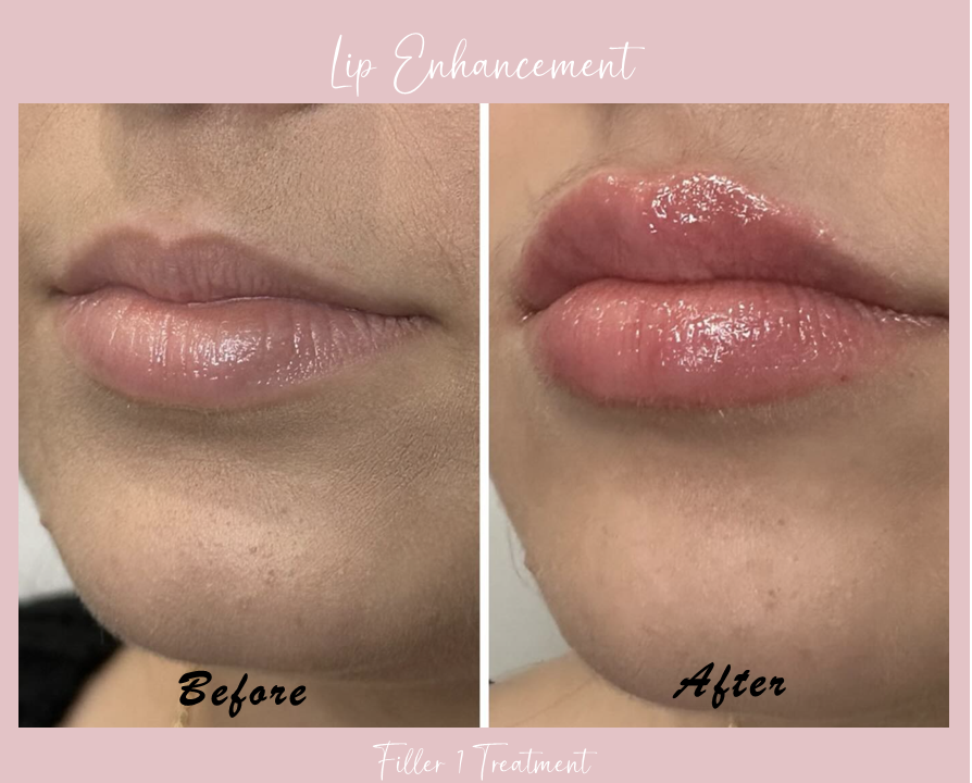 A before and after photo of a woman 's lips.