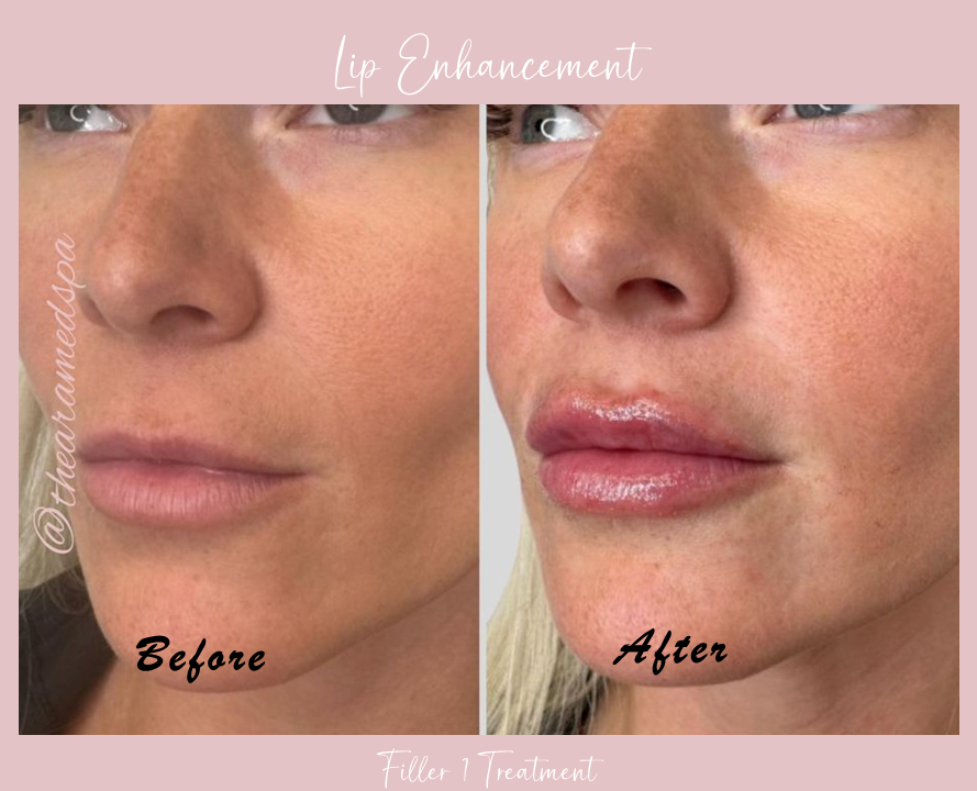 A before and after photo of a woman 's lips.