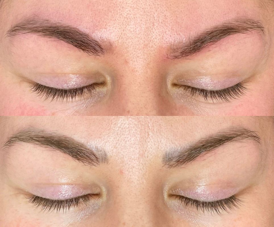 laser-removal-rotterdam