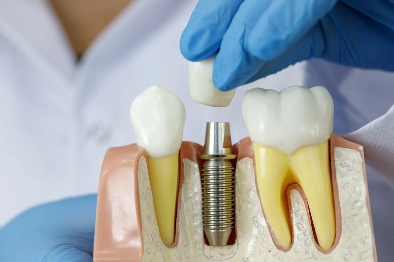 A dentist is holding a model of a tooth with a dental implant in it.