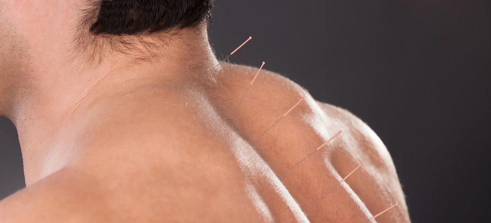 A man is getting acupuncture on his neck and shoulder.