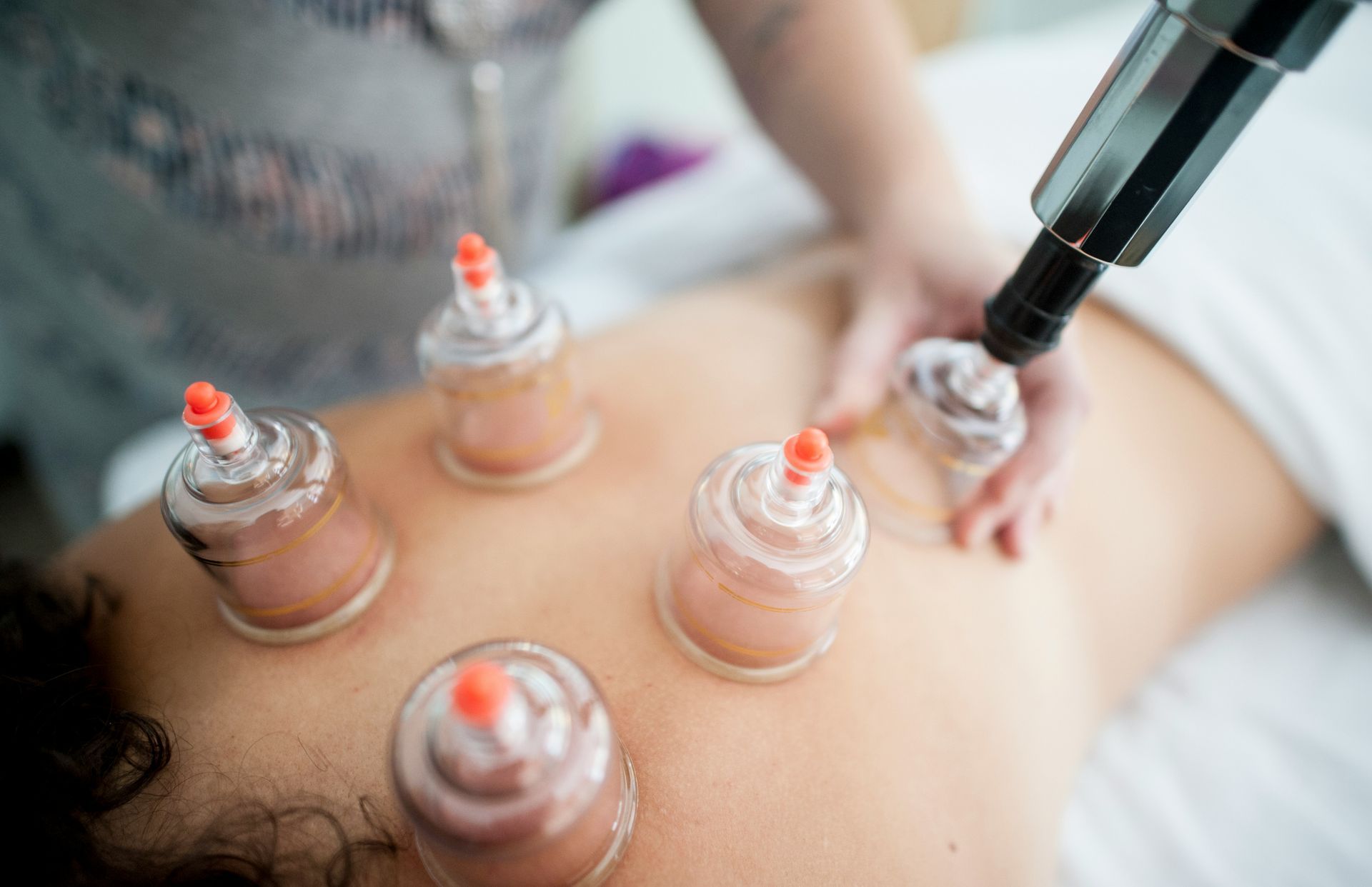 A woman is getting a cupping treatment on her back.