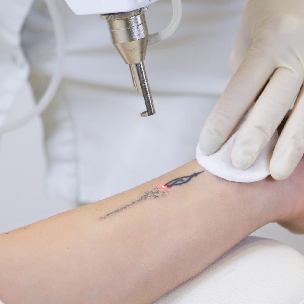 Safe tattoo removal