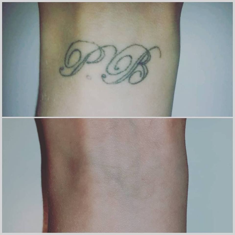 Before and after - Laser tattoo removal