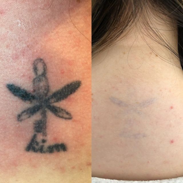 Laser tattoo removal, Wallasey, Wirral Laser Room