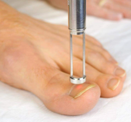 Laser treatment for fungal toe nails