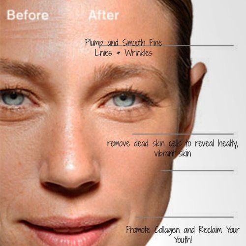 Carbon facial skin treatment