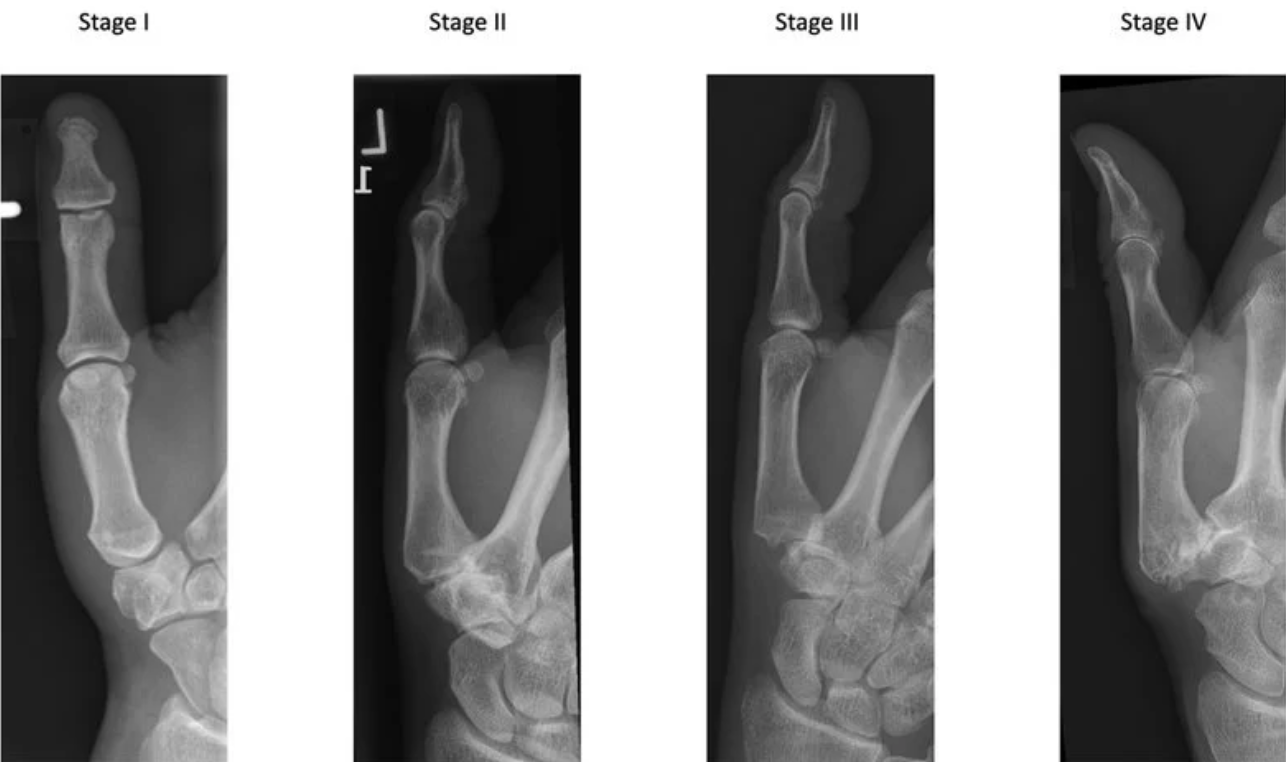 Classificação  de Eaton e Littler