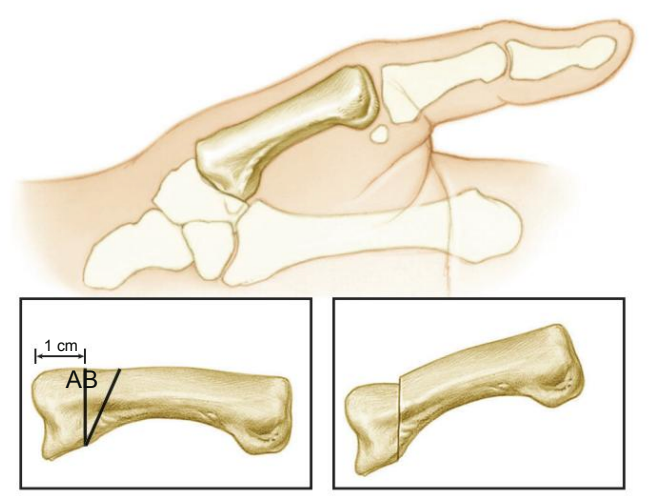 Osteotomia do primeiro metacarpo
