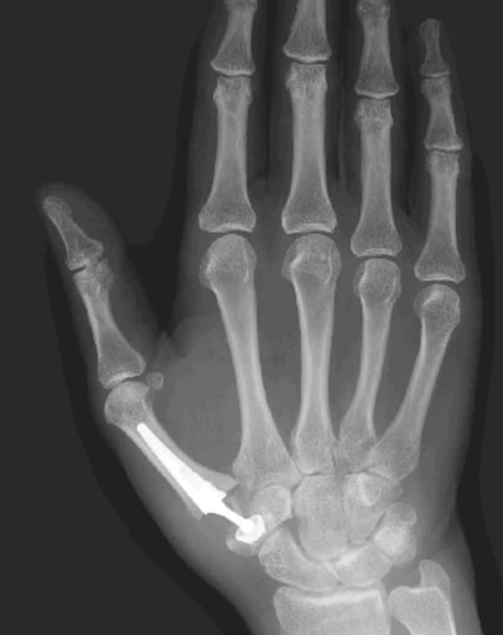 Artroplastia ( protese)