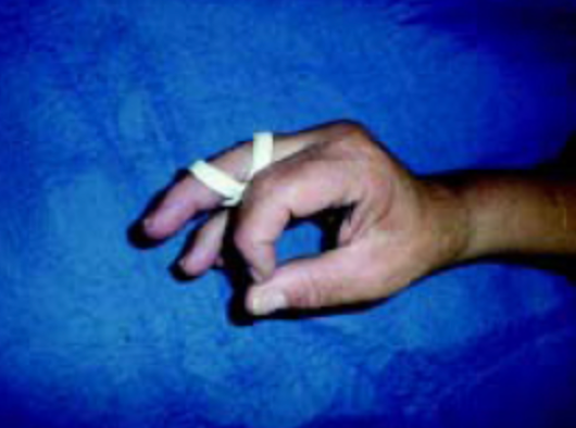 Ortese para tratamento conservador