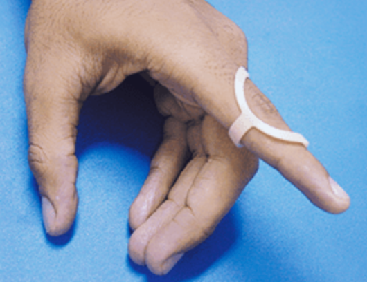 Ortese para tratamento conservador