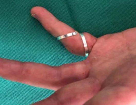 Ortese para tratamento conservador