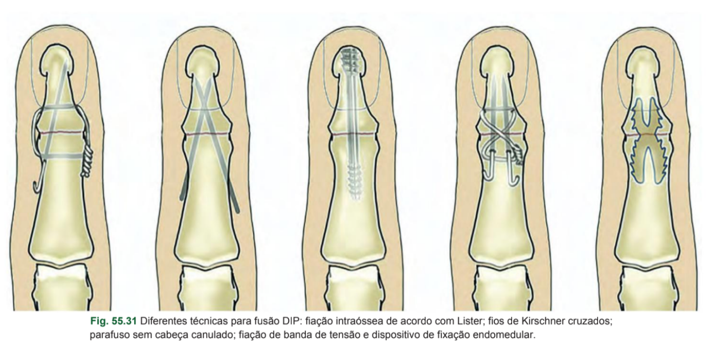 Técnicas cirúrgicas para artrodese