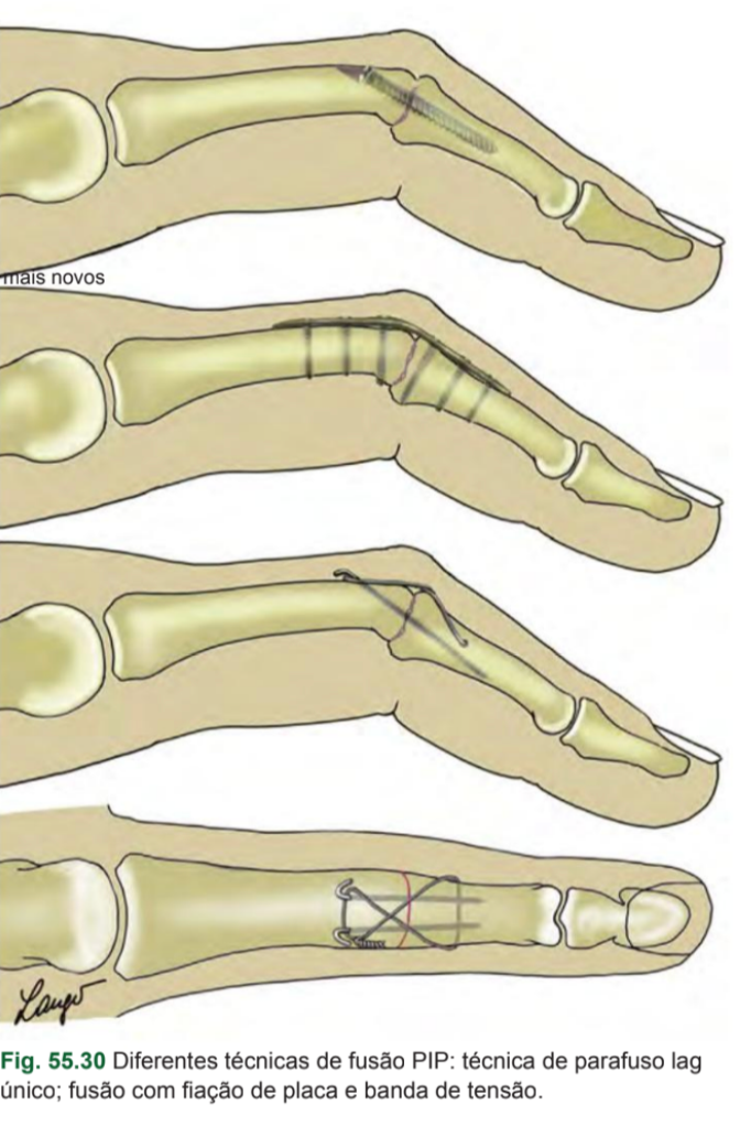 Técnicas cirúrgicas para artrodese