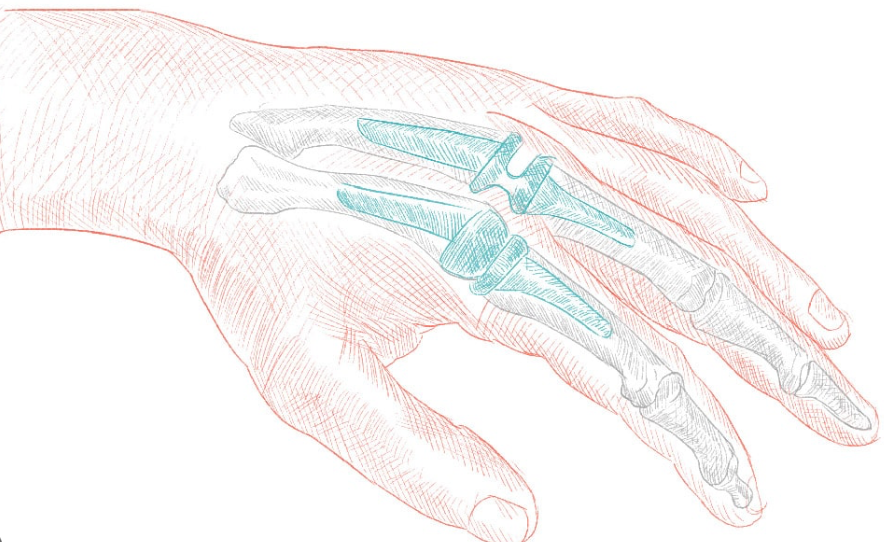 Artroplastia com protese