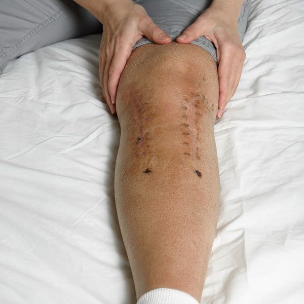 A person's post-surgery knee on a white surface, showing two rows of surgical staples and two dark circular incisions.