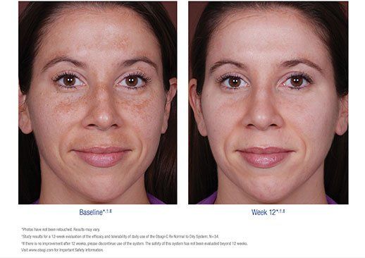 Obagi CRX before and after picture