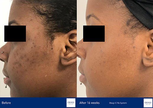 Obagi CRX before and after pictures