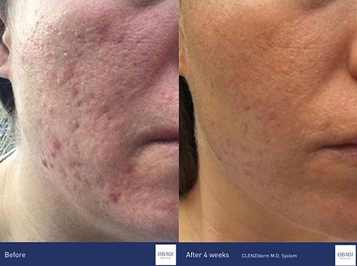 OBAGI CLENZIDERM Before and After