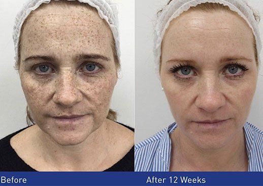 Obagi CRX treatment before and after pictures