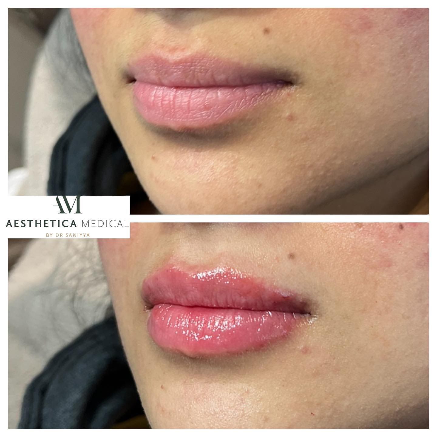 lip filler before and after
