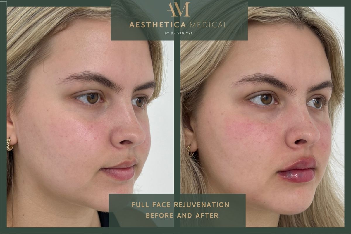 Full face rejuvenation before and after