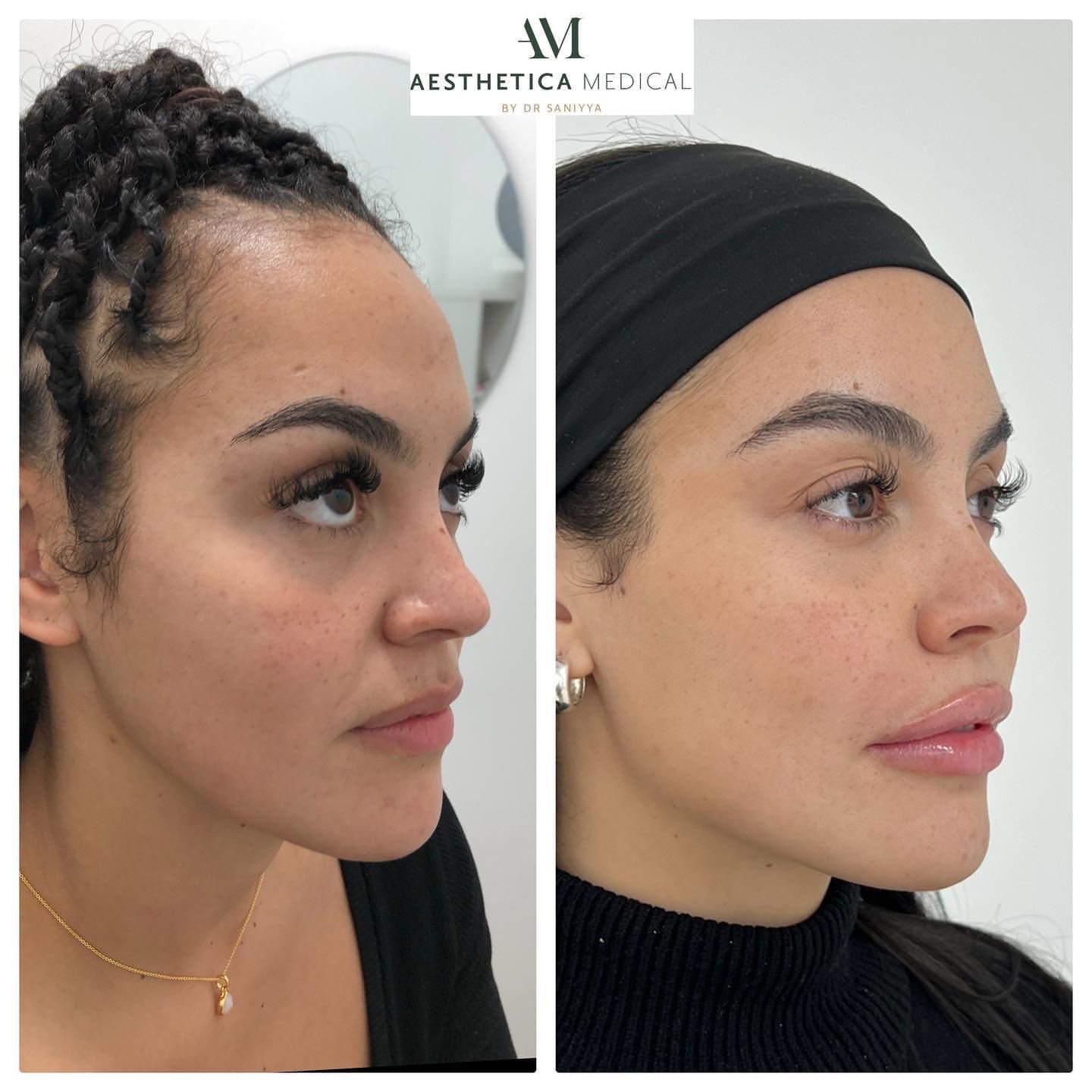 full face rejuvenation