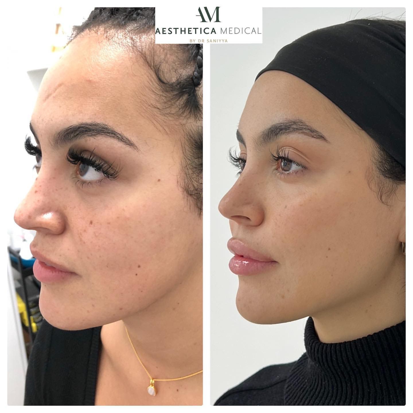 fullface rejuvenation before and after pics