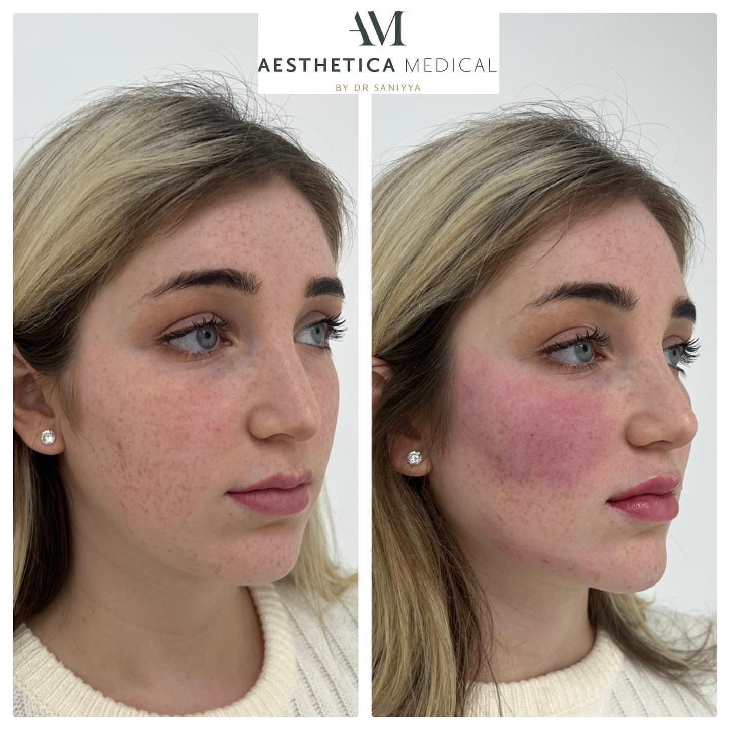 full face rejuvenation b4 and after