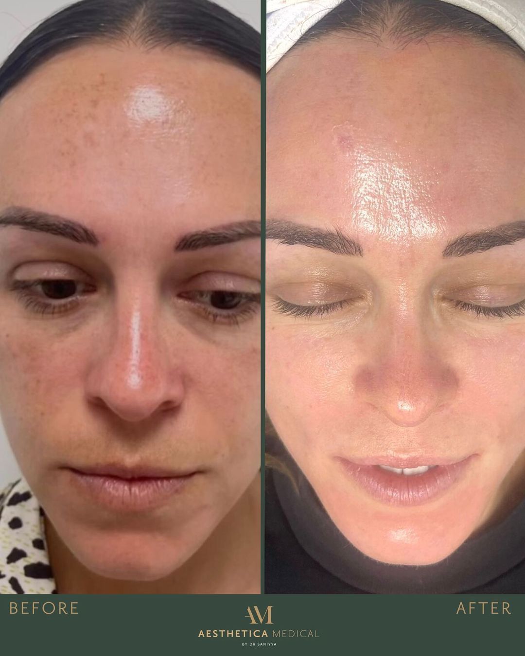Hydrafacial before and after pictures