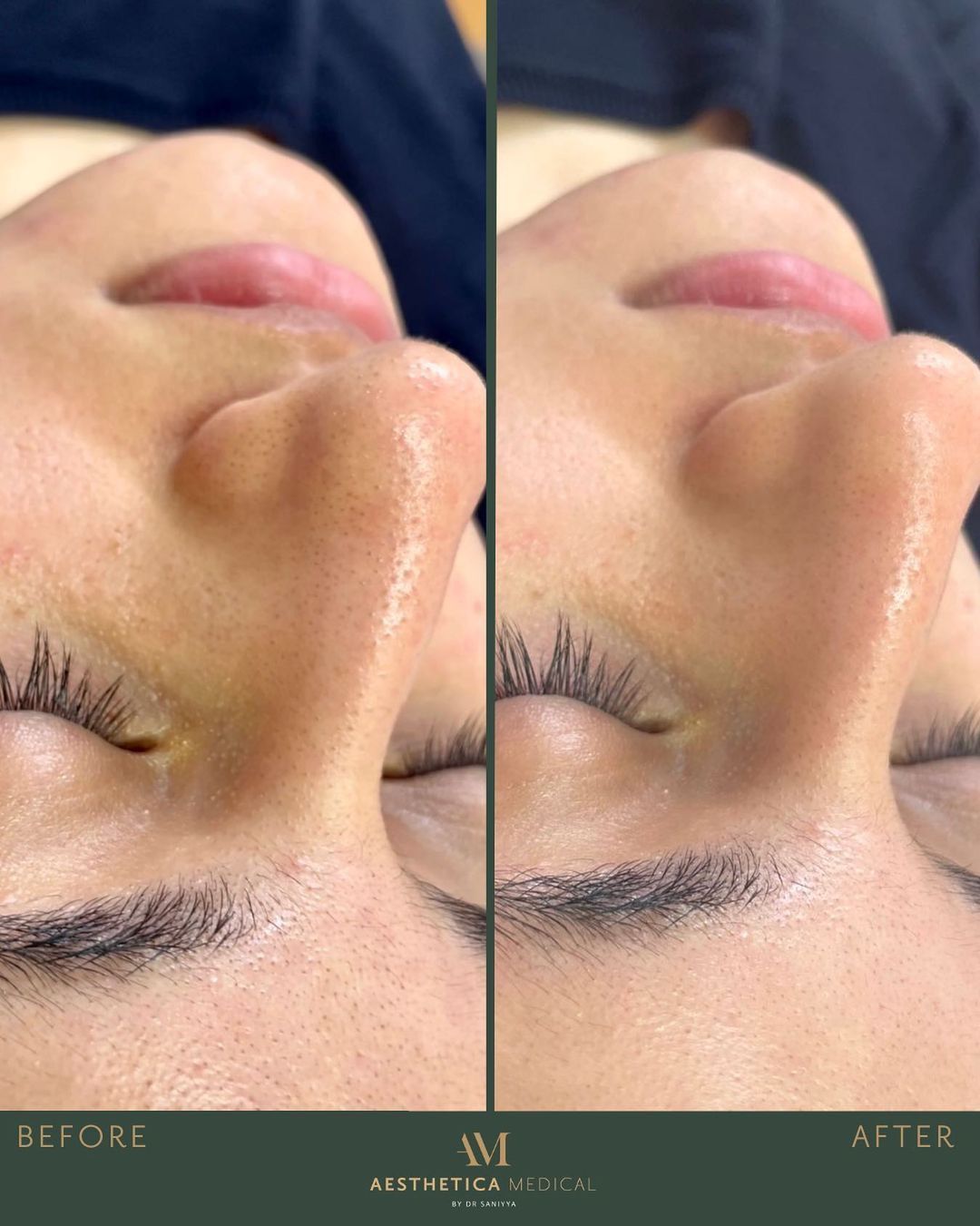 Hydrafacial Treatment Before and After
