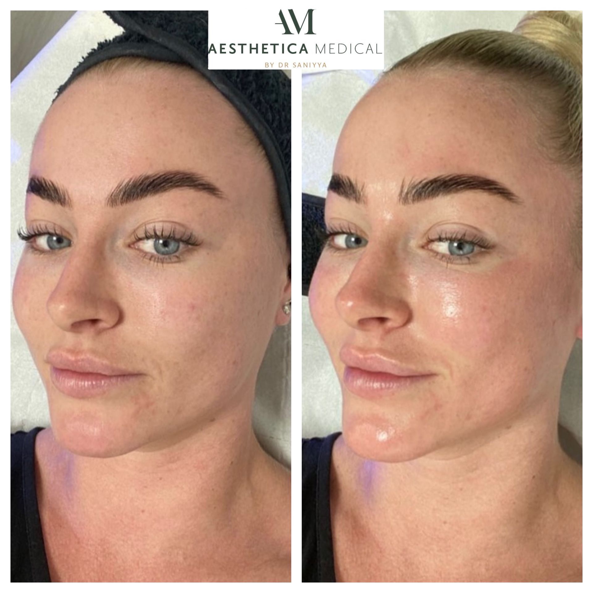 A before and after photo of a woman 's face.