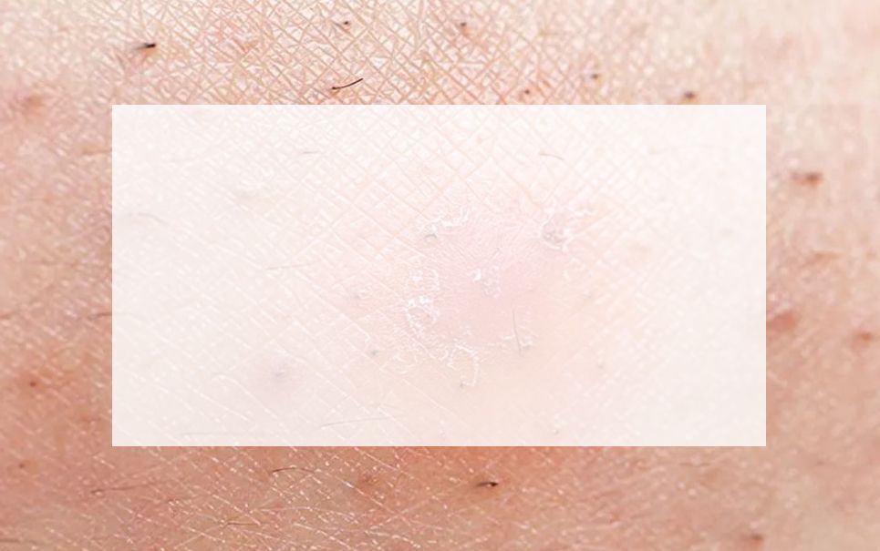 Ingrown Hair Image