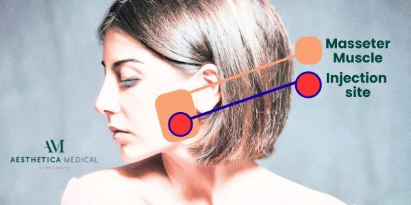 Masseter muscle and masseter botox injection sites