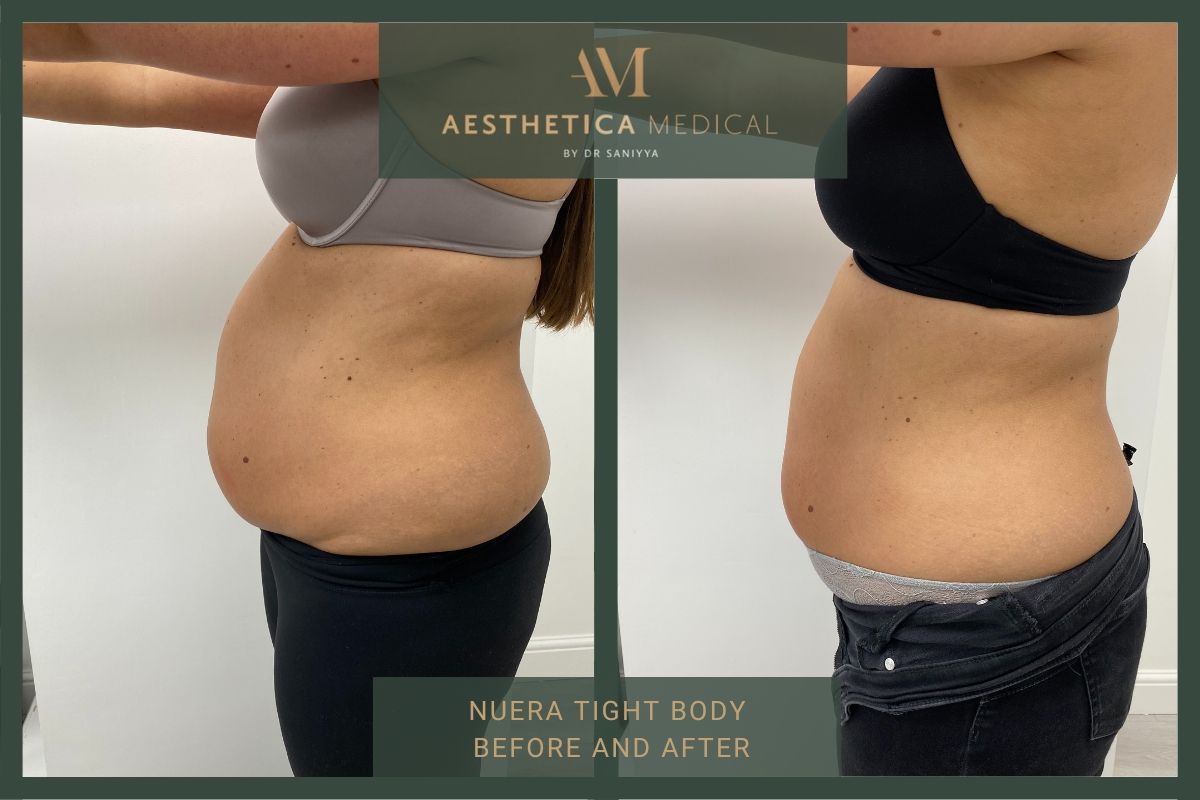 Nuera Tight Body  Before And After