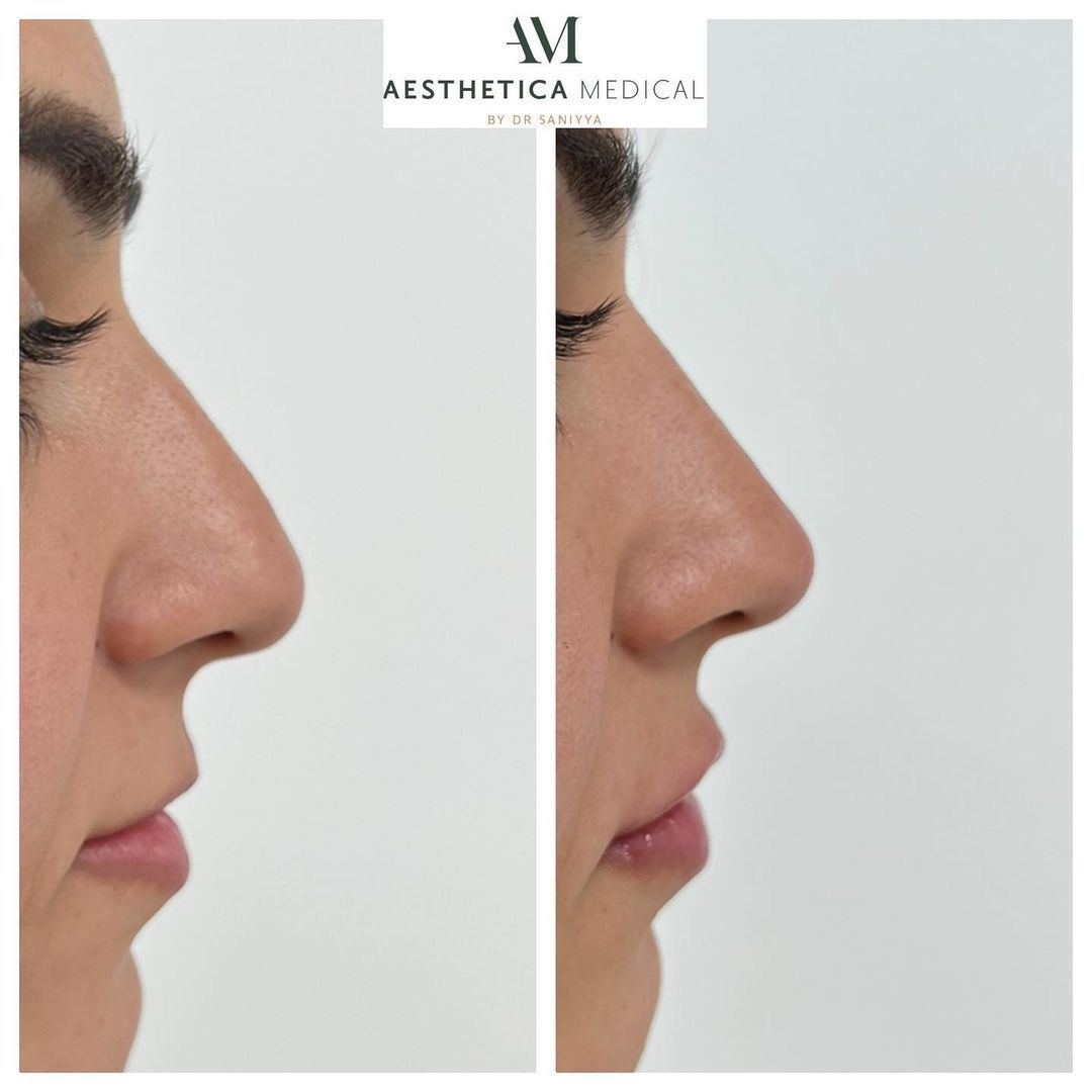 Before and after Liquid nose job