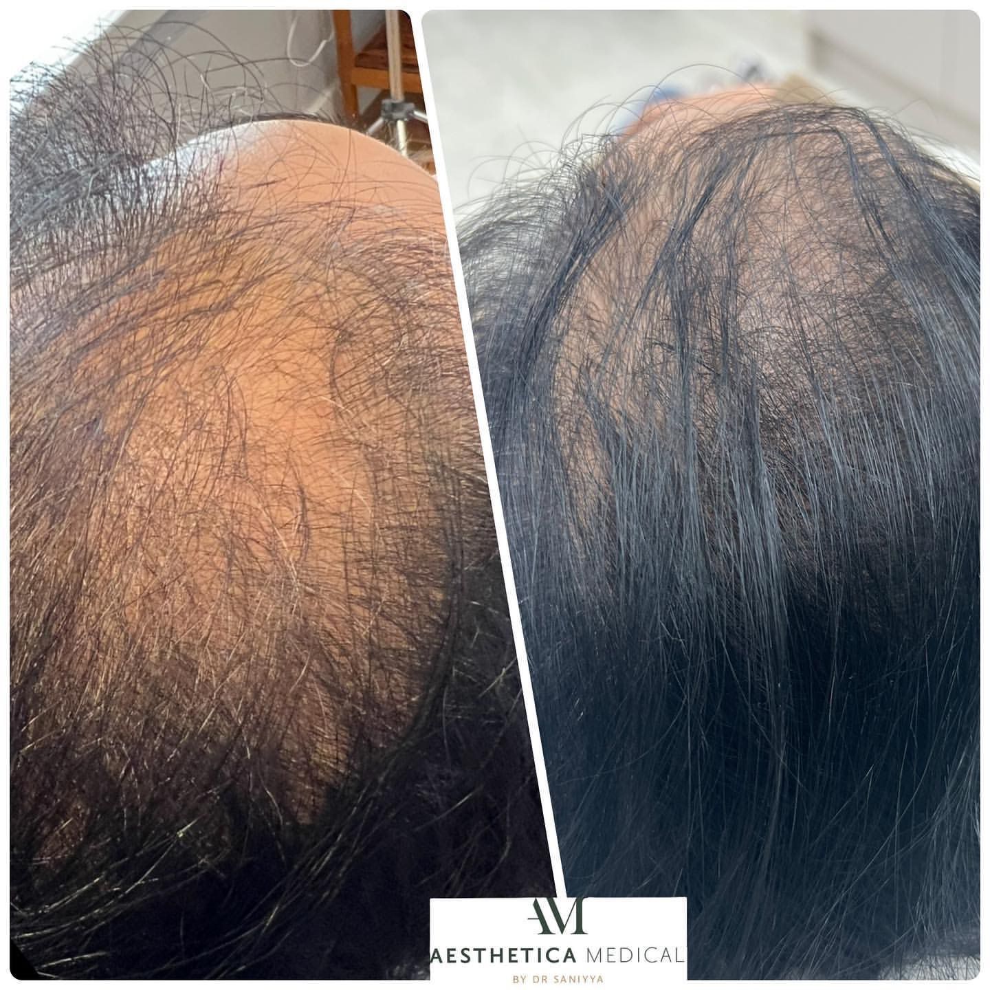 prp for hair loss before and after photos