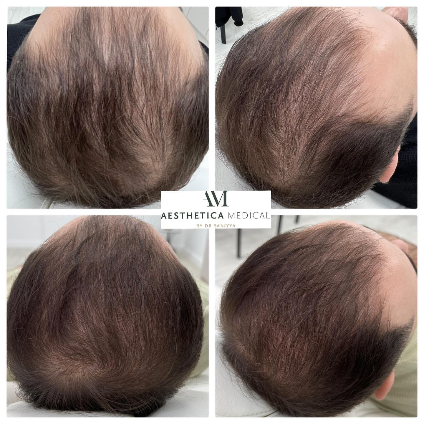 PRP for hair loss before and after pictures