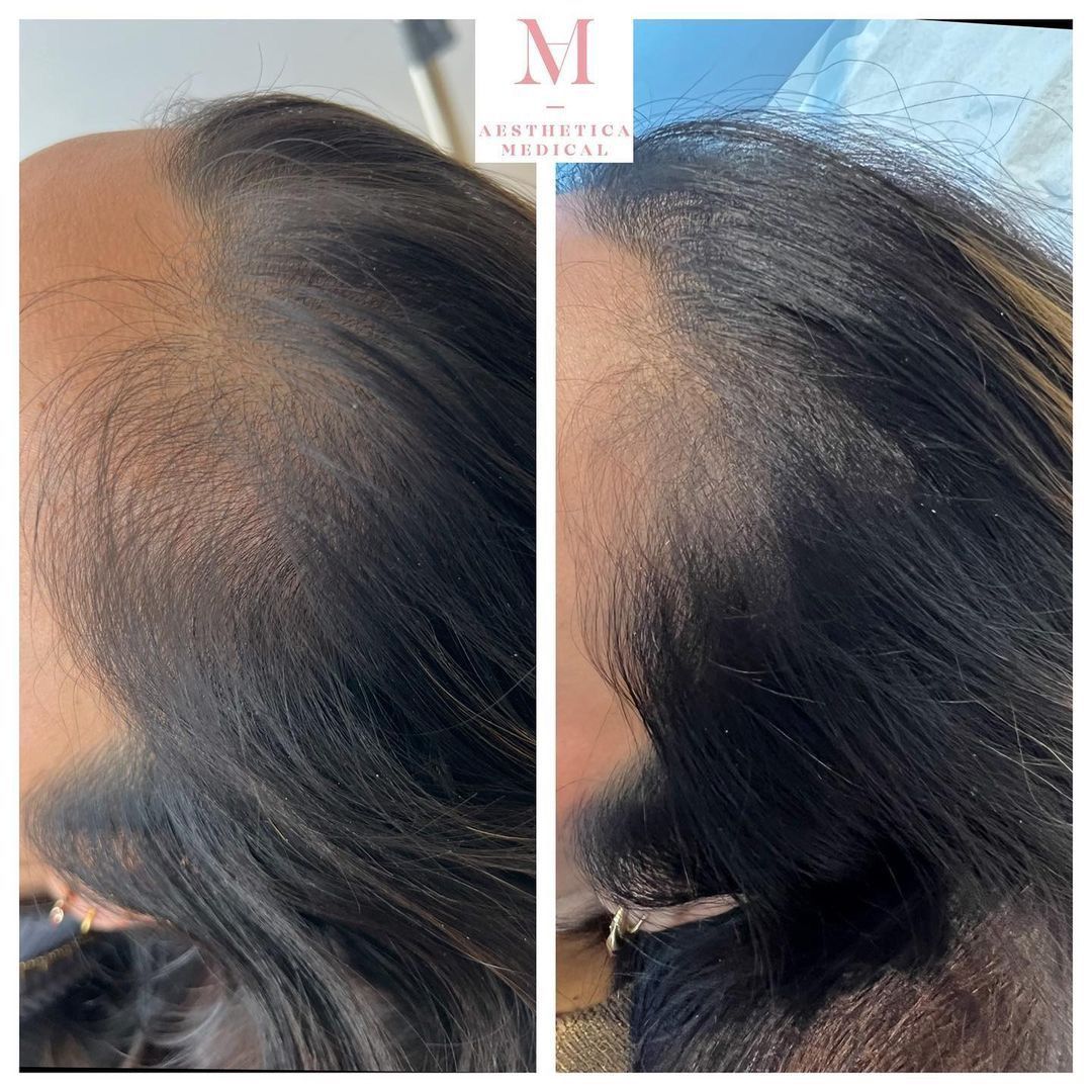 prp for hair loss before and after