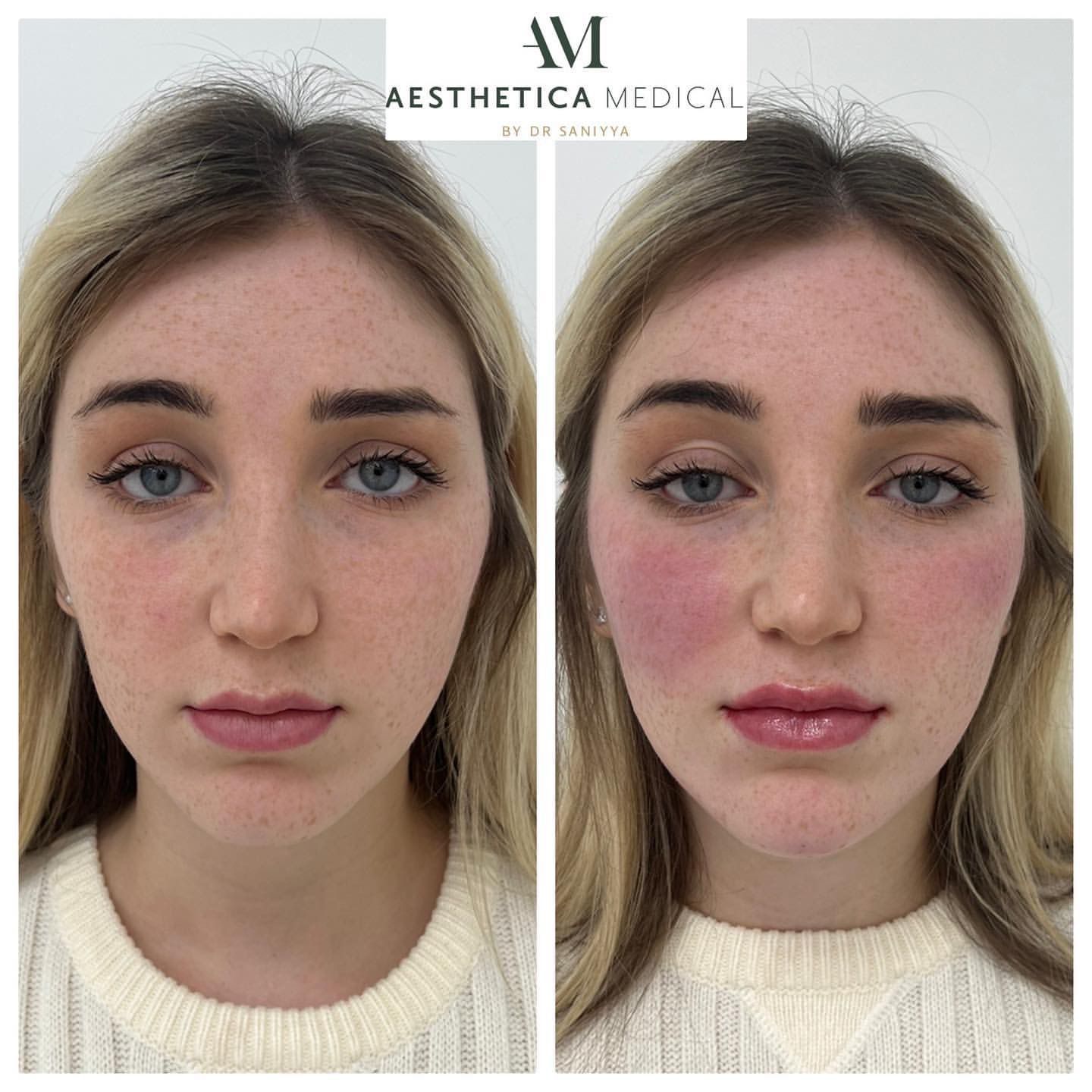 full face rejuvenation photots