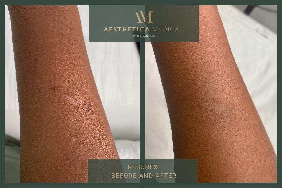 Thread Vein Removal Before And After