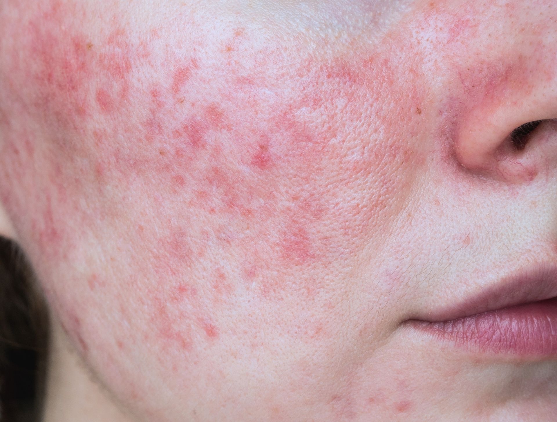 Expert Rosacea Treatment Doctor-Led Clinic In Leeds