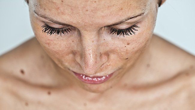 Sun Damage Treatment Leeds Cheshire Skin Repair Solutions