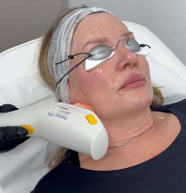 Pre-care for IPL dark spot removal in Ponte Vedra, FL — Stellar M22 by Lumenis